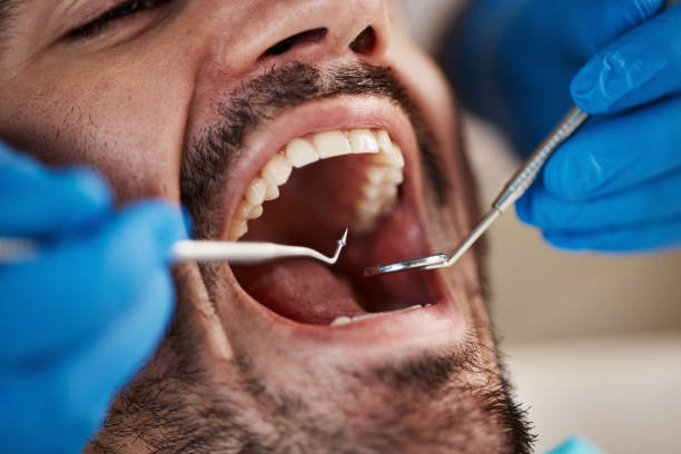 Best Emergency Wisdom Tooth Extraction in Kodi Station, AK